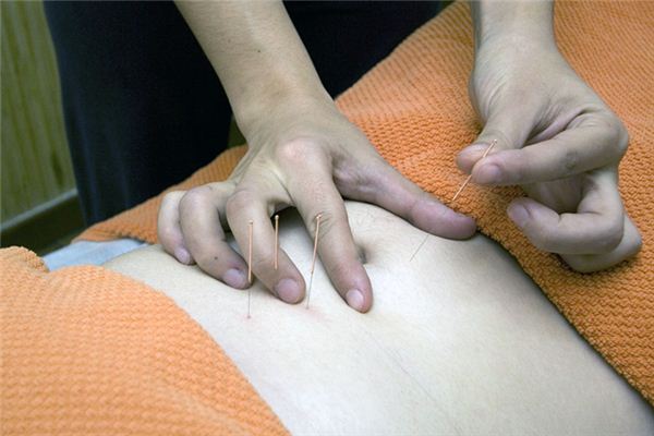 梦见针灸是什么意思 梦见针灸是什么意思